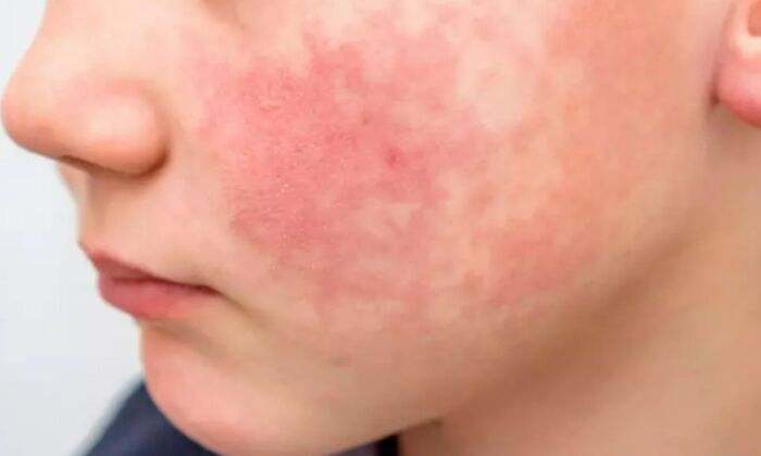Alerta por repunte del virus de la 'bofetada' en colegios y guarderías: estos son los síntomas de la infección