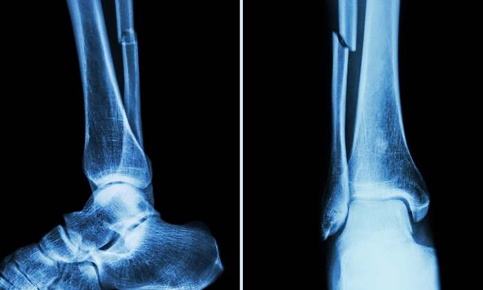 Radiografía de una fractura de peroné