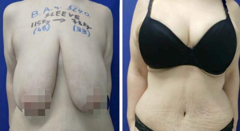 liposuccion-notimex-770.jpg