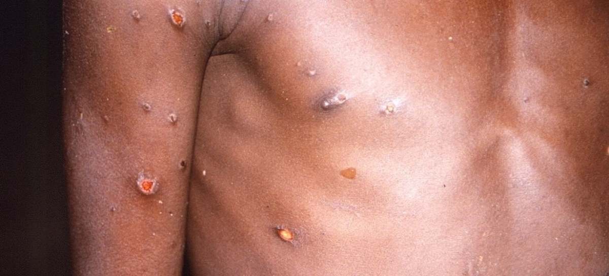 Torso de una persona con mpox o viruela del mono