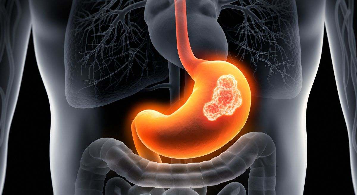 Científicos detectan una nueva causa del cáncer de estómago: "Observamos un mayor número de mutaciones en células normales"