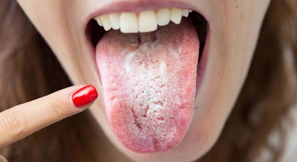 Una mujer con la lengua blanca