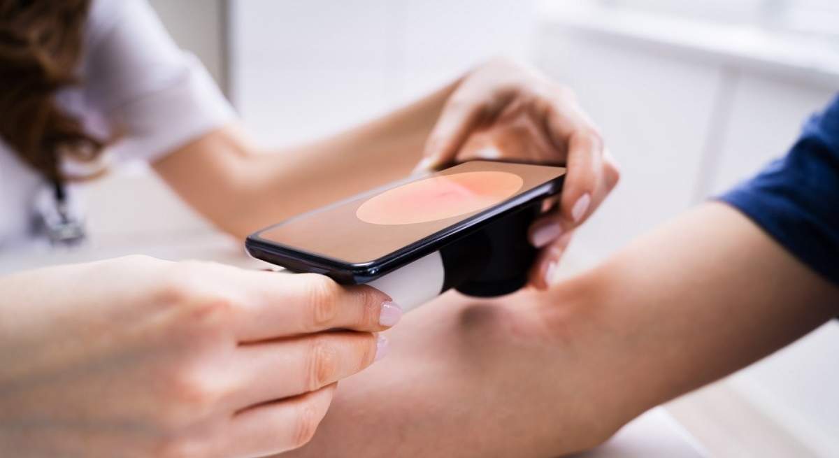 melanoma.jpg