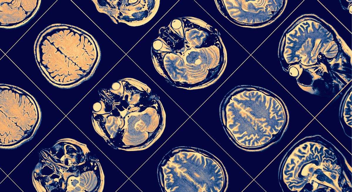 Cáncer cerebral