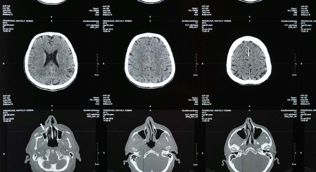 Enfermedades cerebrales