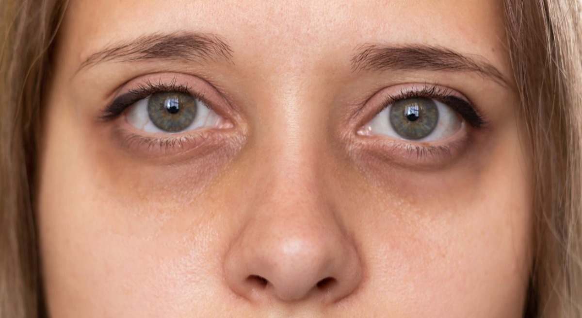 Mujer con ojeras