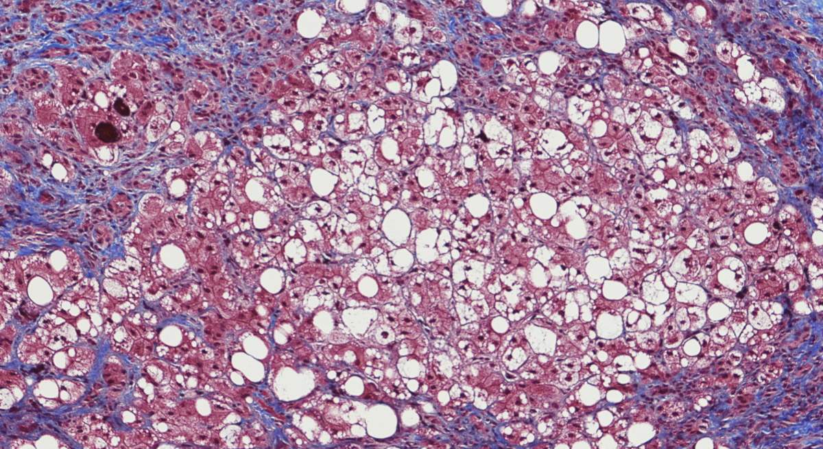 hepatittis.jpg