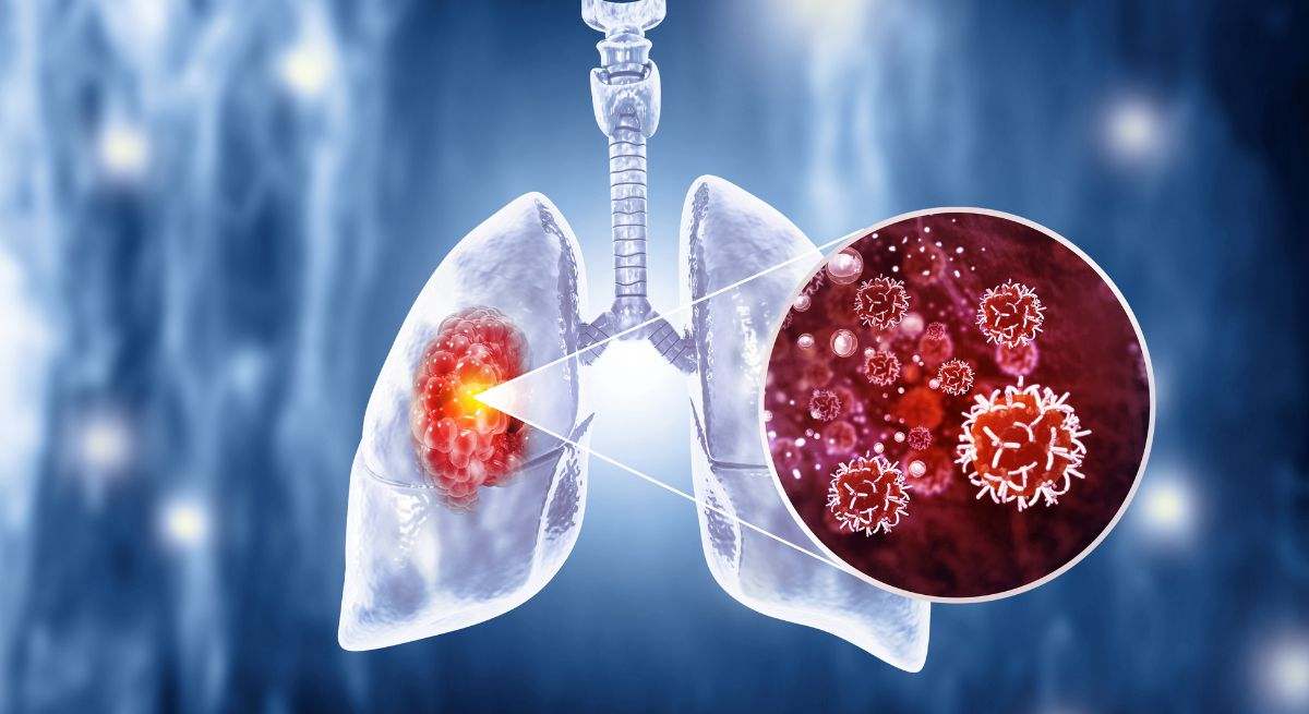 Imagen descriptiva del cáncer de pulmón.