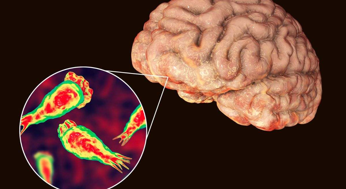 Infección de ameba en el cerebro