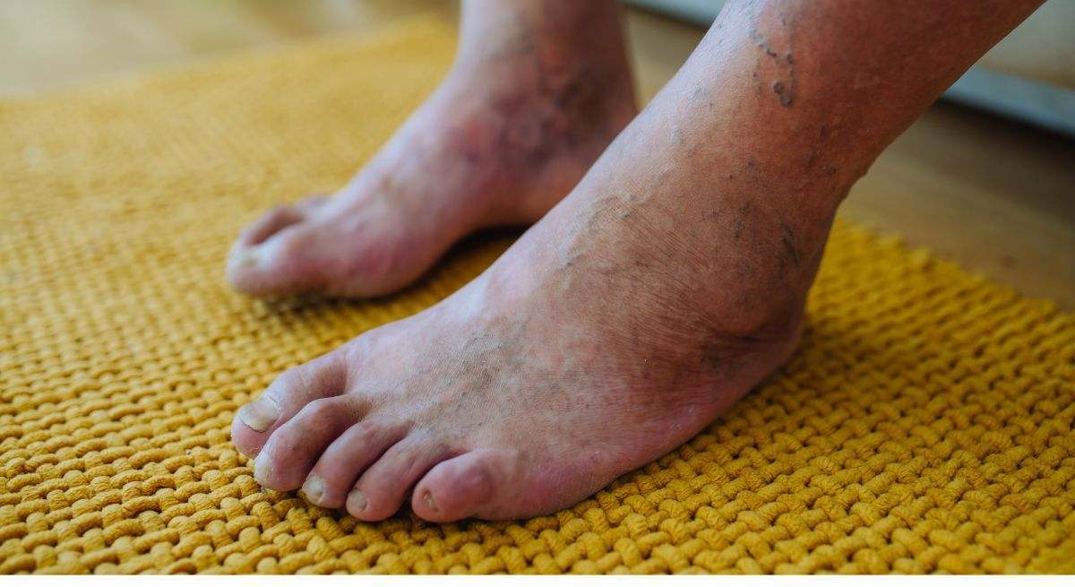 El pie diabético es una complicación grave de la diabetes