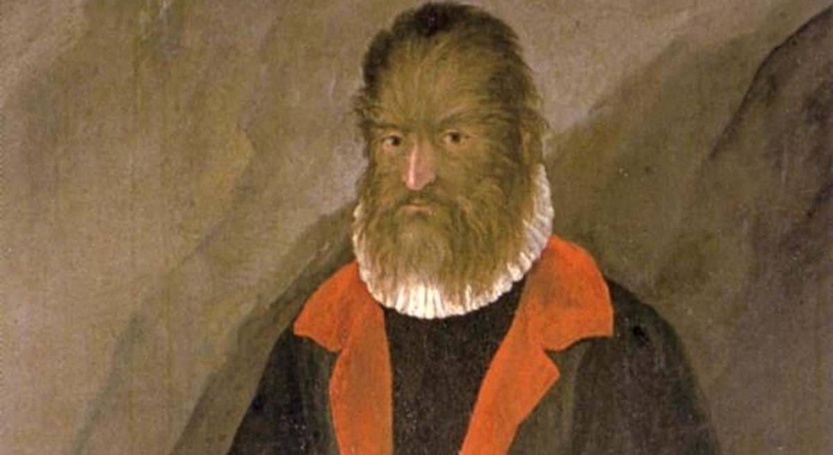 Dibujo de Petrus Gonsalvus del caso conocico más antiguo de 'síndrome del hombre lobo'