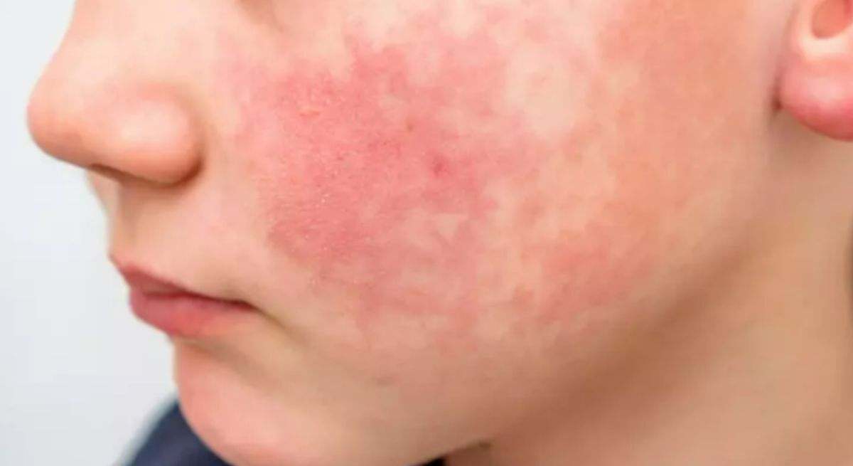Aúmentan los casos del "virus de la bofetada": qué es, cómo se transmite y síntomas de la enfermedad en menores