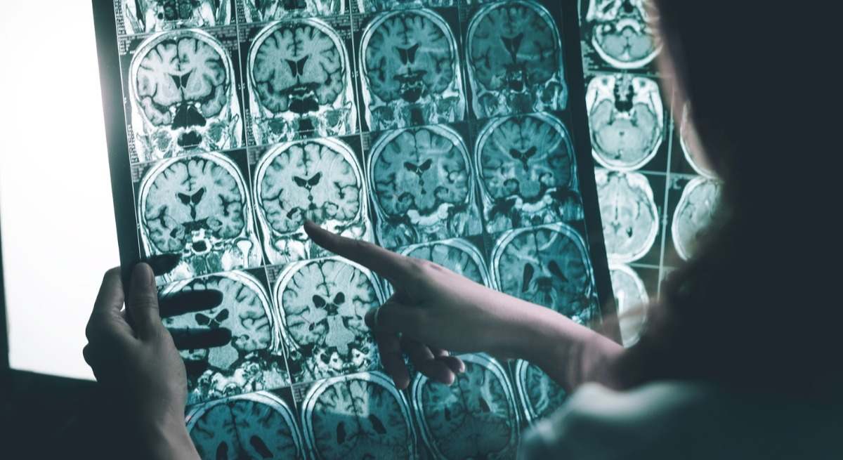 Alzheimer