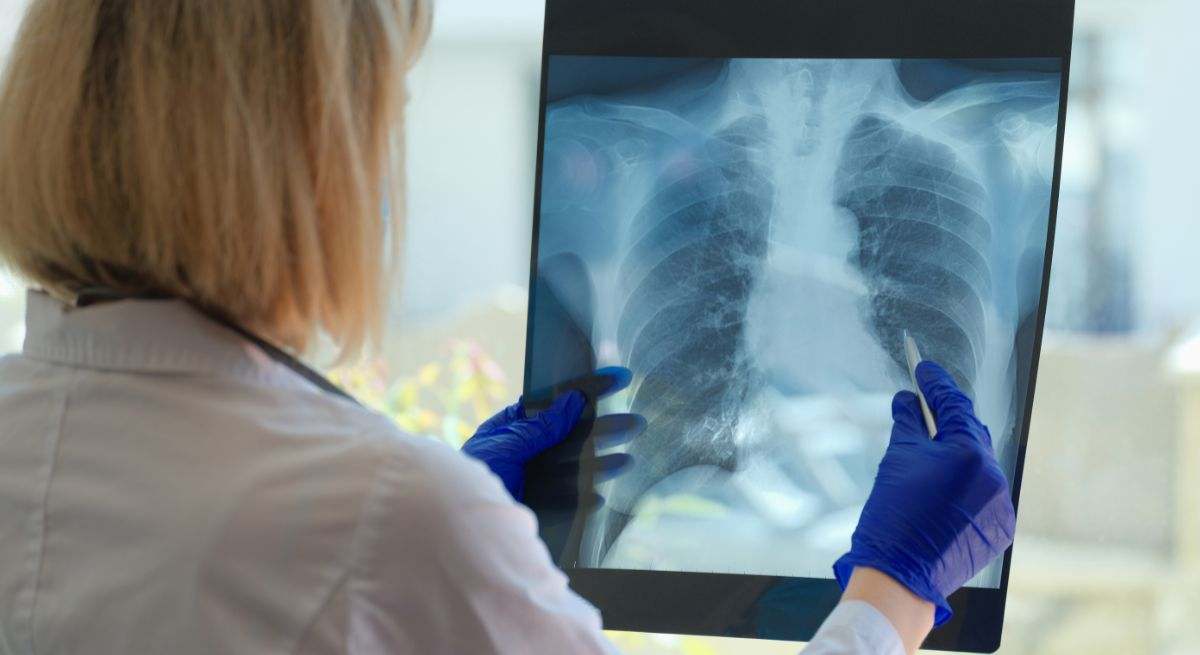 El cáncer de pulmón puede estrechar la vía respiratoria y provocar sibilancias