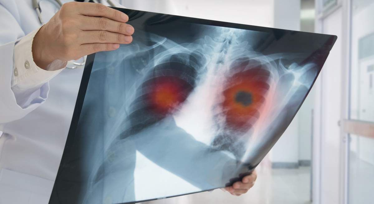radiografia-cancer-pulmon.jpg
