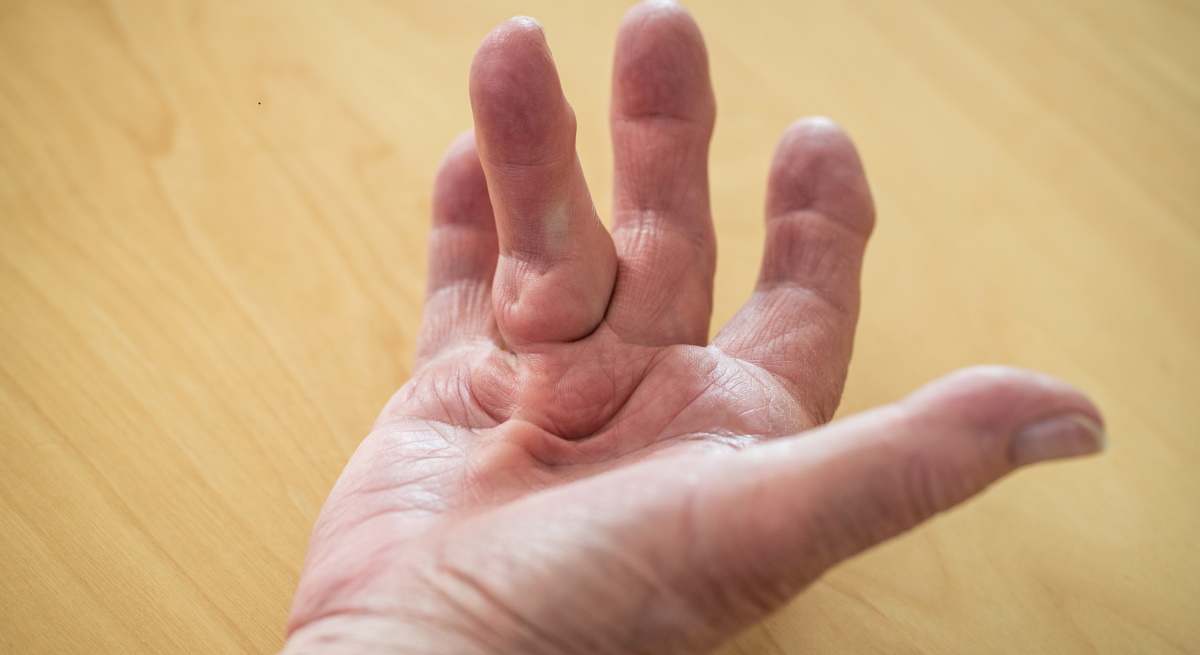 enfermedad-dupuytren-origen-istock.jpg
