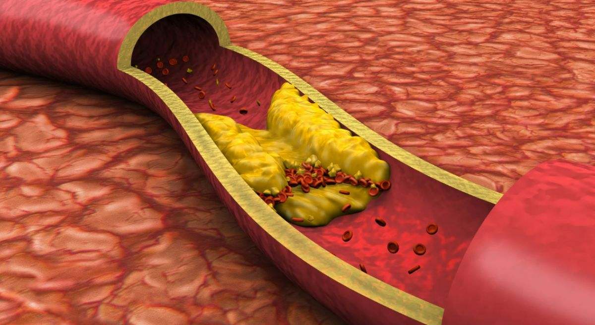 Una investigación cuestiona la 'hipótesis lipídica' en personas metabólicamente sanas