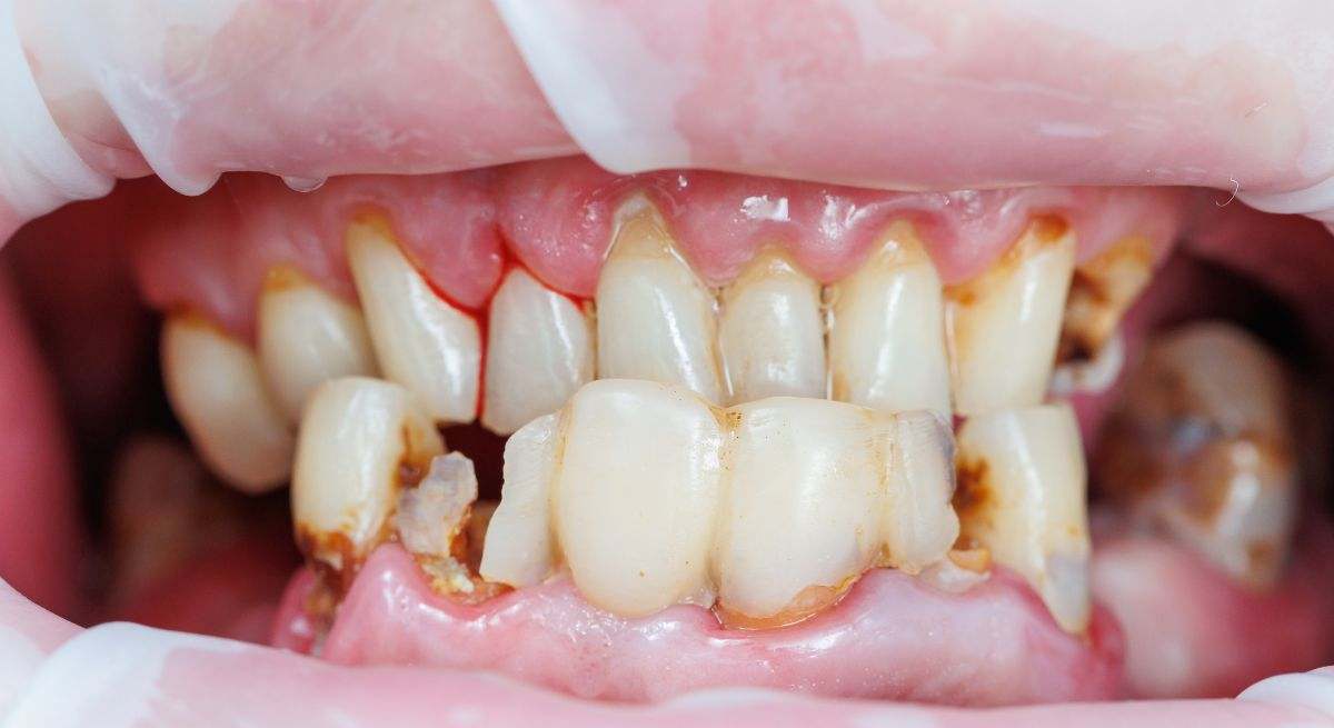 El sarro es la placa dental que no ha sido eliminada y se ha endurecido