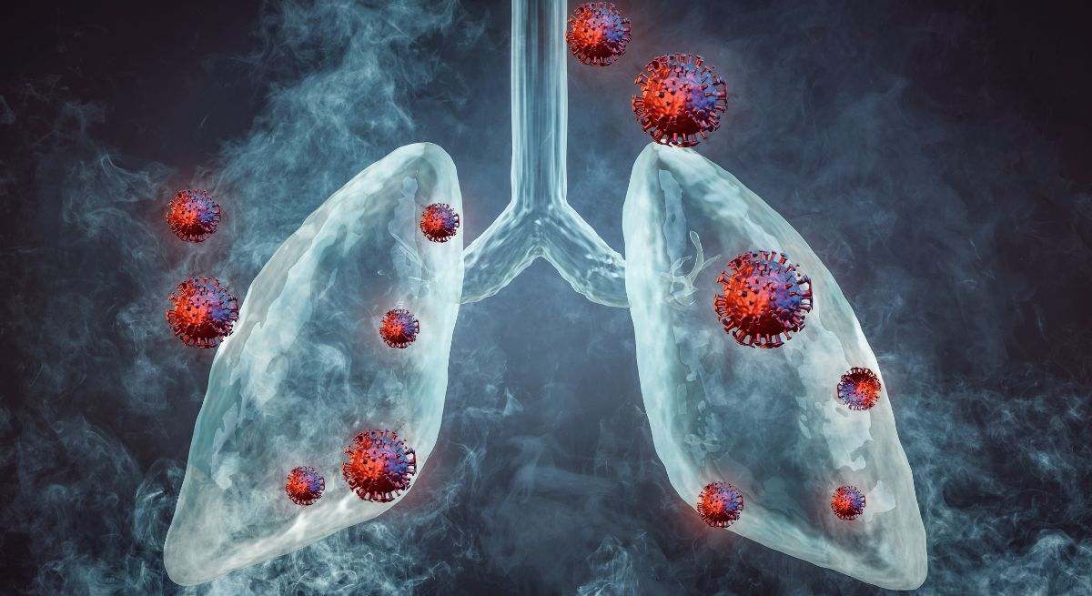El cáncer de pulmón puede estrechar la vía respiratoria y provocar sibilancias