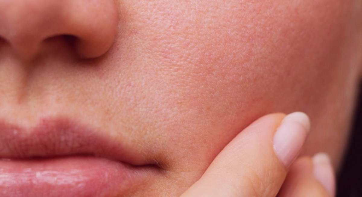 El retinol puede provocar sequedad en la piel