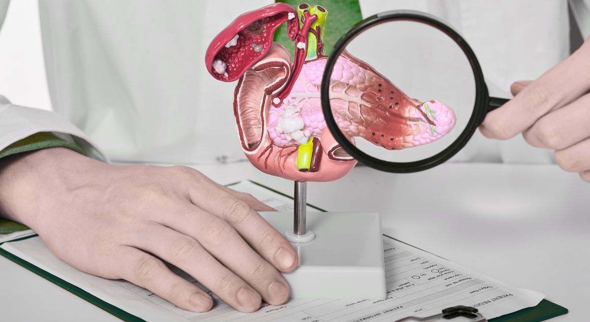 Cáncer de páncreas