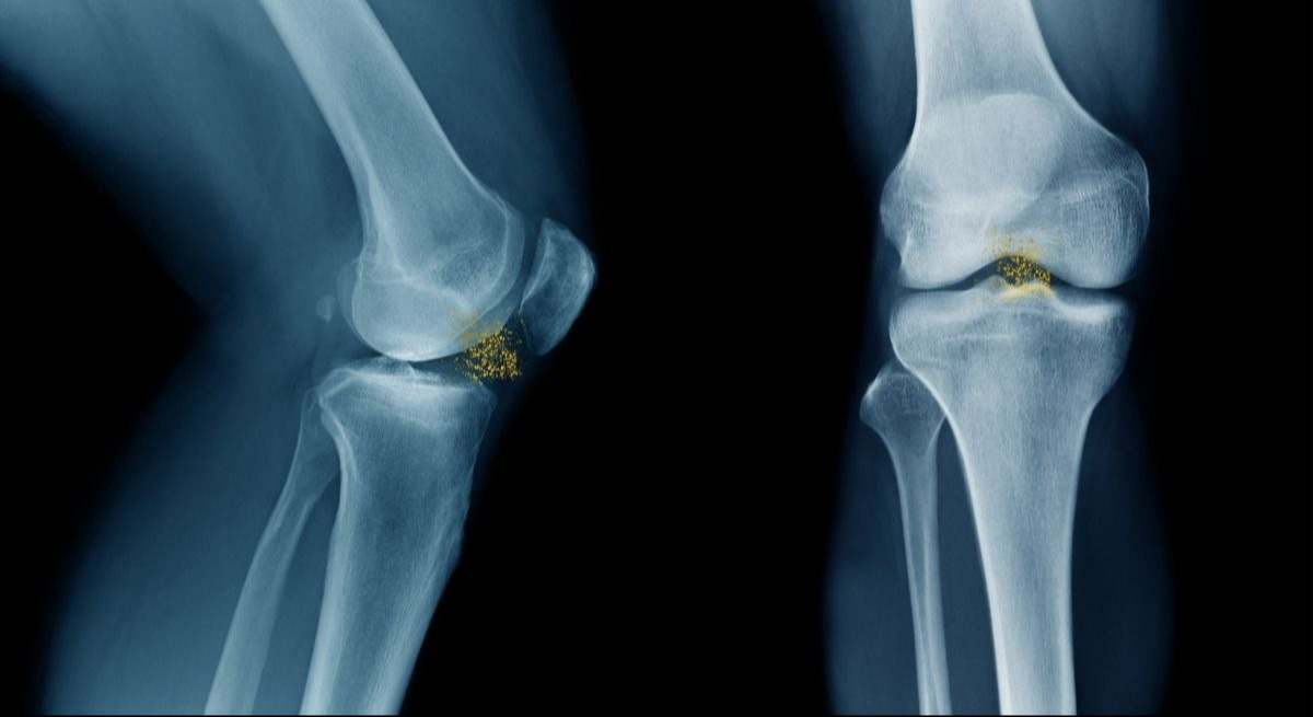 radiografia-rodilla