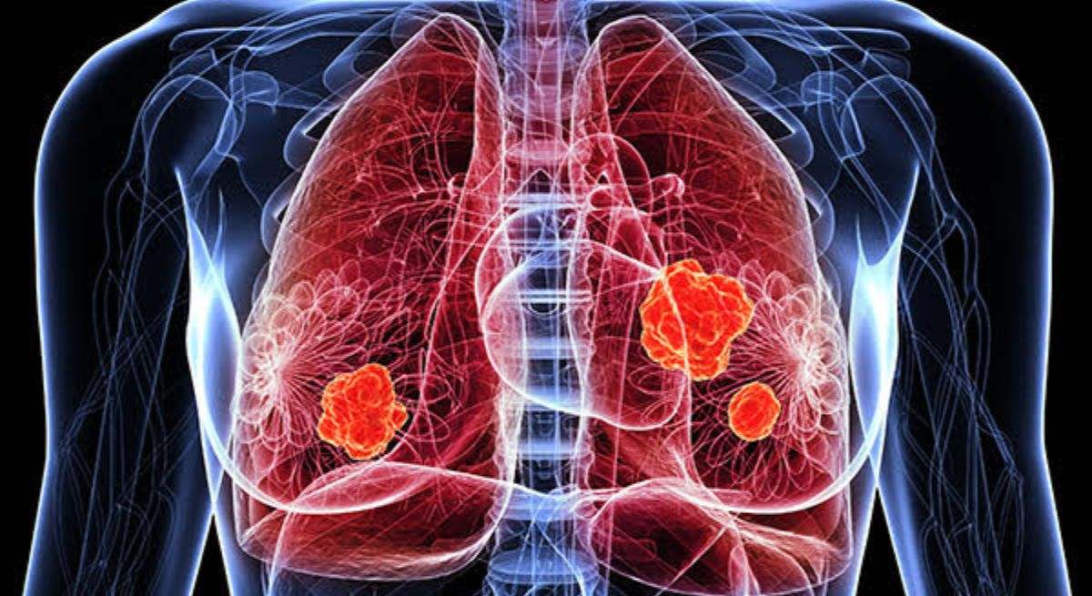 Grafía de cáncer de pulmón