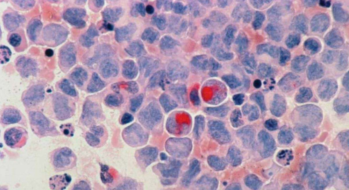 Las tasas de supervivencia de algunos pacientes con leucemia mieloide aguda podrían duplicarse con una prueba de médula ósea sensible