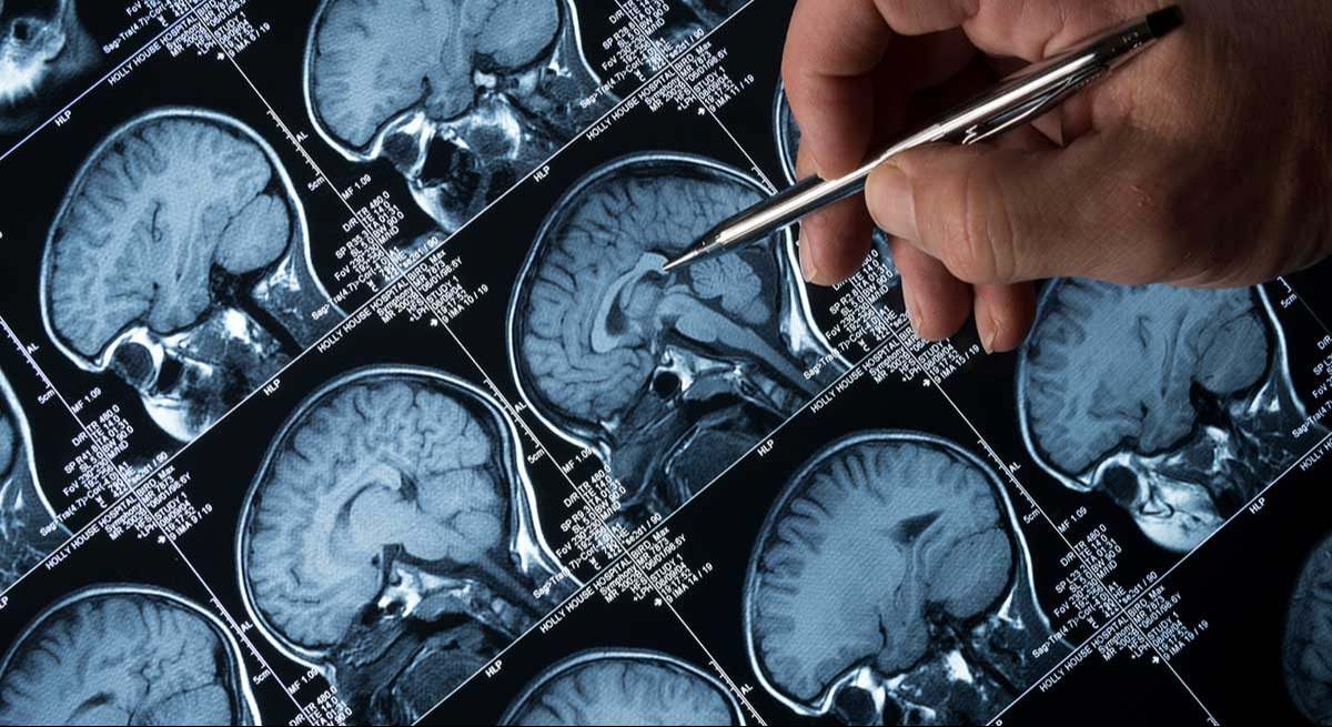 epilepsia 