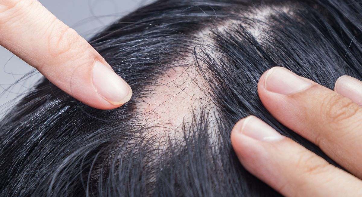 Alopecia androgénica