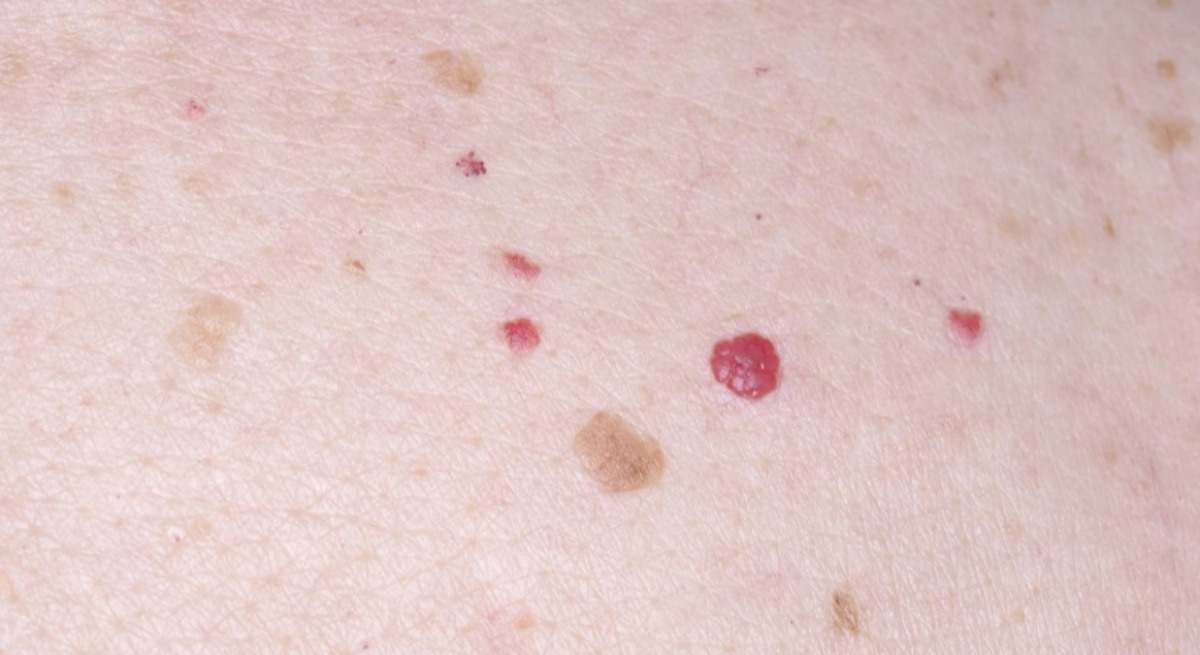 Angiomas rubí o seniles.