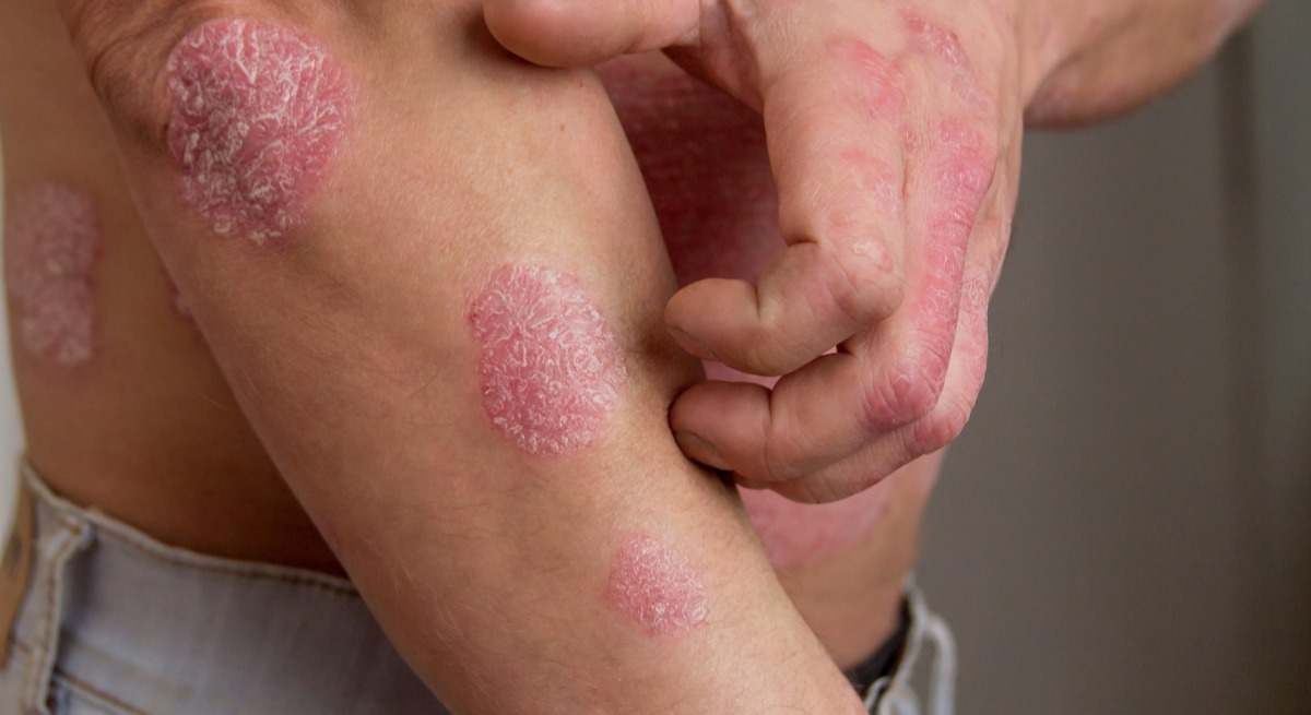 Tener grasa en esta parte del cuerpo multiplica las probabilidades de padecer psoriasis.