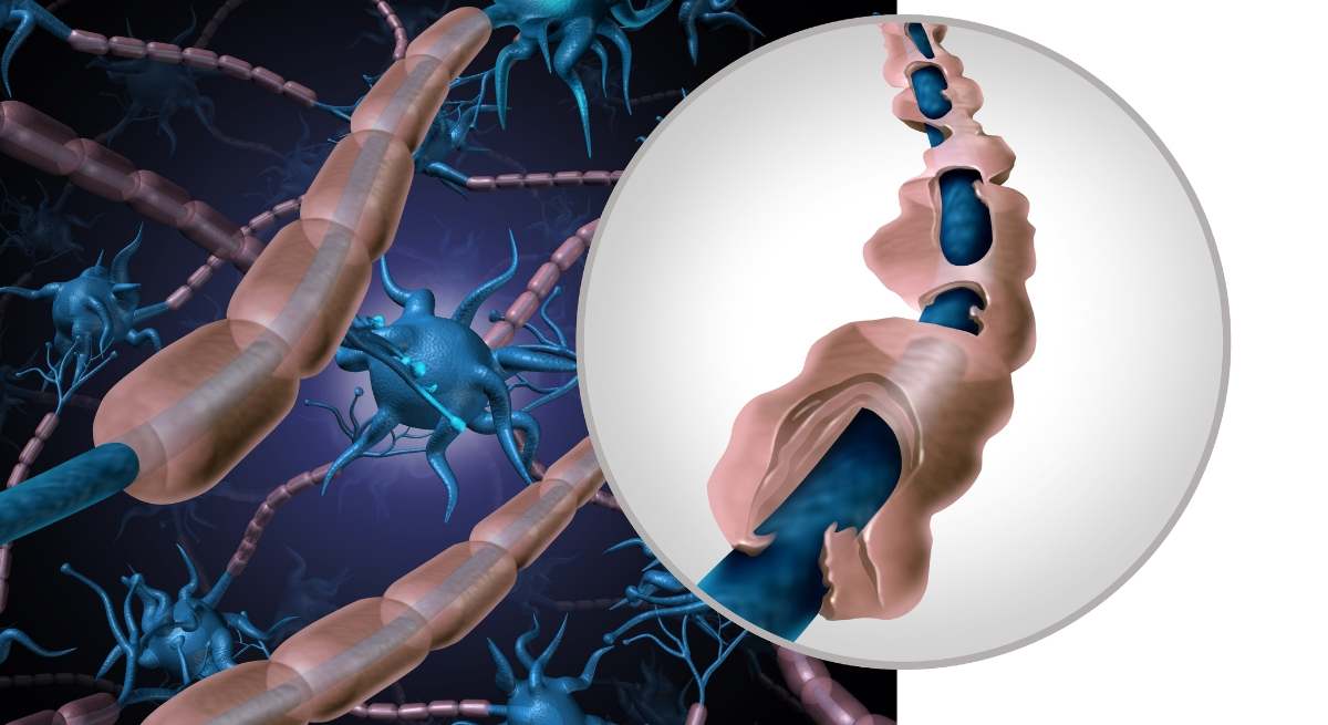 Herramienta capaz de predecir cómo avanzará la esclerosis múltiple.