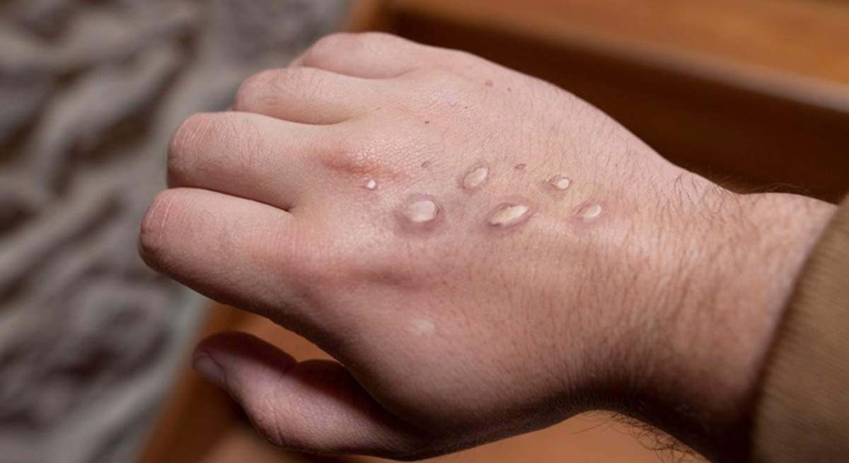 Un caso de viruela del mono o mpox