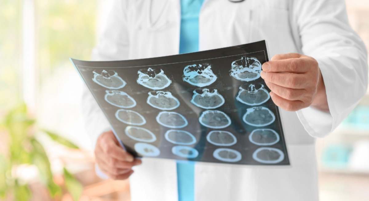 Hallan un biomarcador en sangre capaz de predecir cómo evolucionará el Alzheimer.