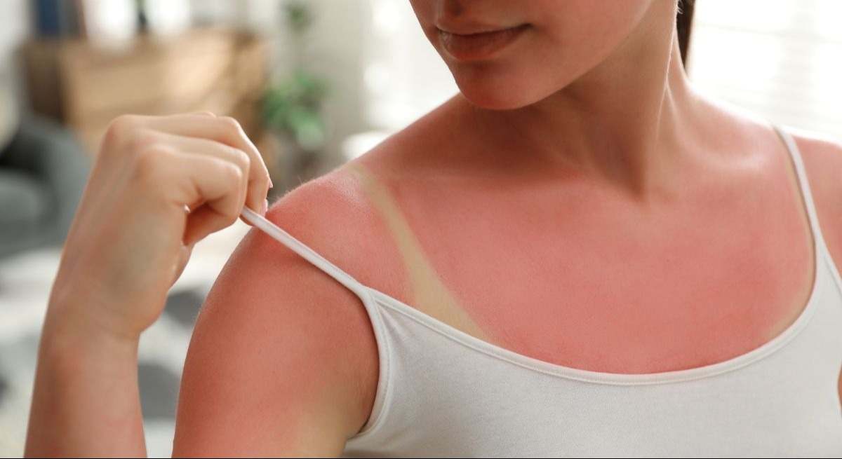 Mujer con quemadura solar