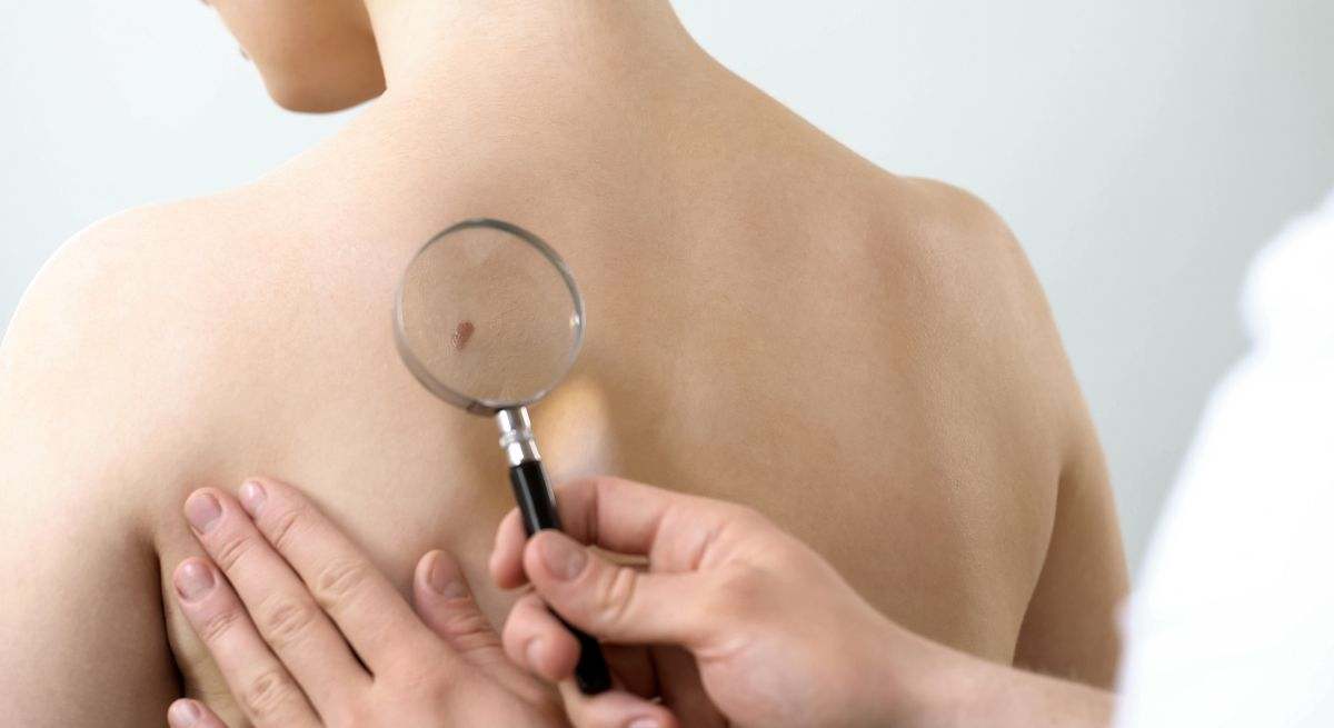 El cáncer de piel es muy peligroso