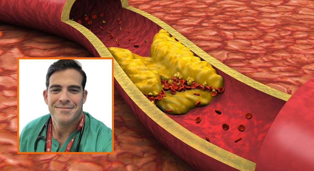Aurelio Rojas, cardiólogo, junto a una ilustración de una arteria con colesterol