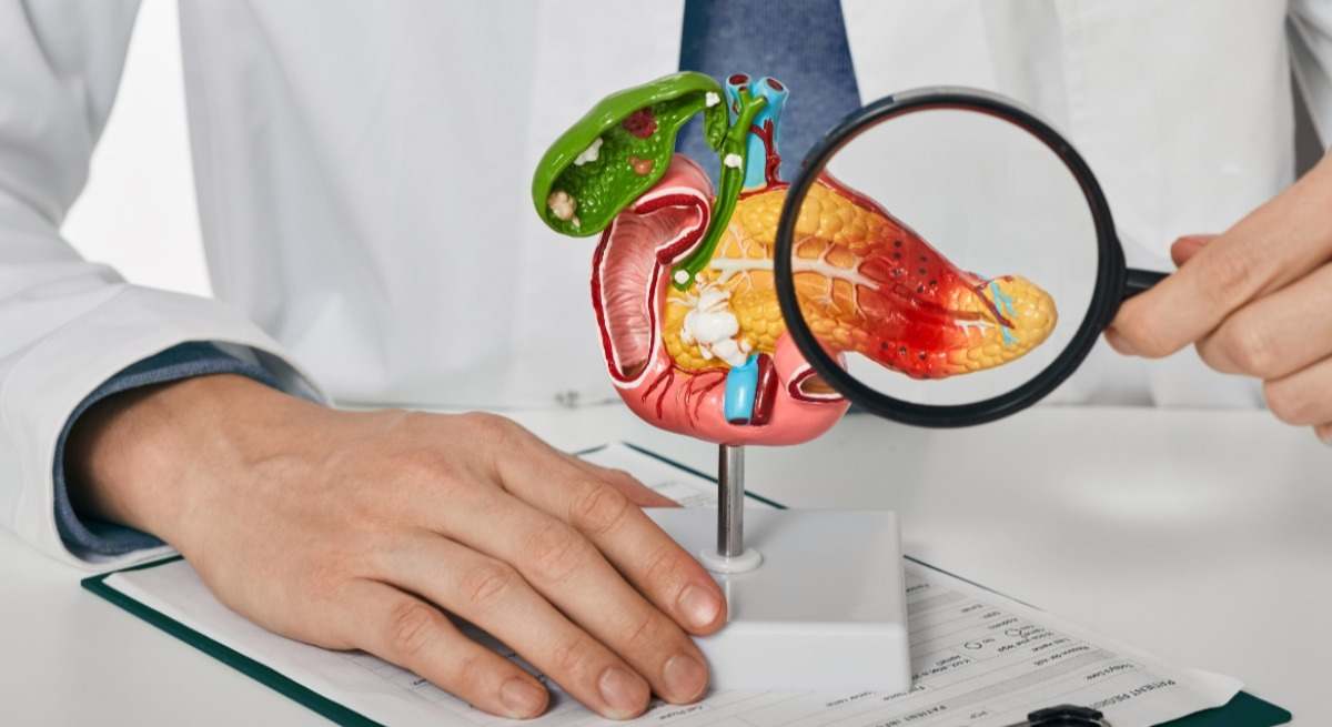 Cáncer de páncreas.