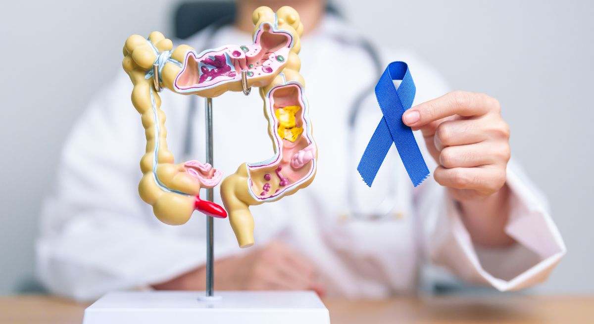 Cáncer de colón