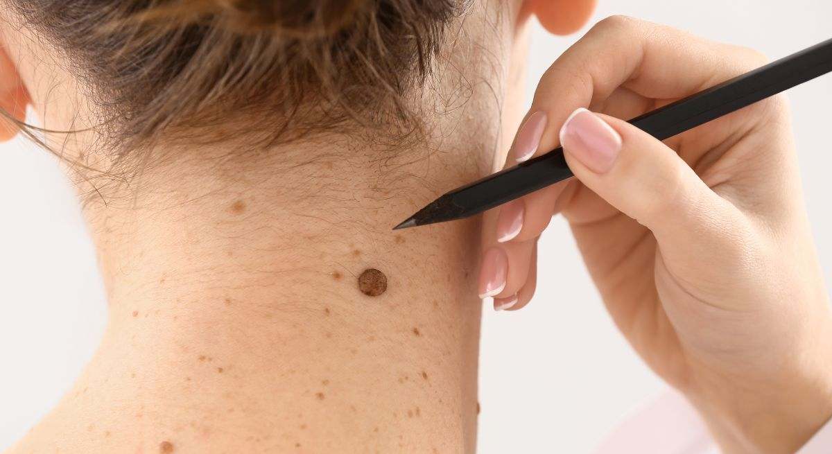 El cáncer de piel es uno de los tumores de mayor incidencia en el ser humano