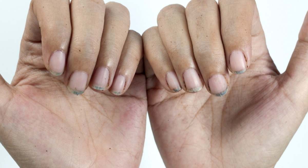 Las uñas, un foco de bacterias e infecciones.