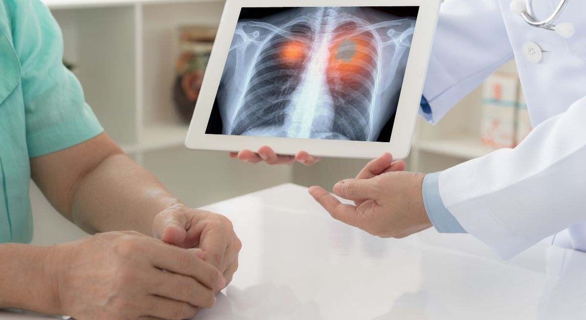 Cáncer de pulmón