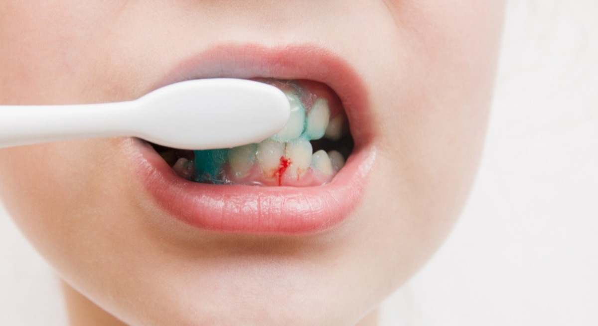 Cuidado si te sangran las encías al cepillarte los dientes.