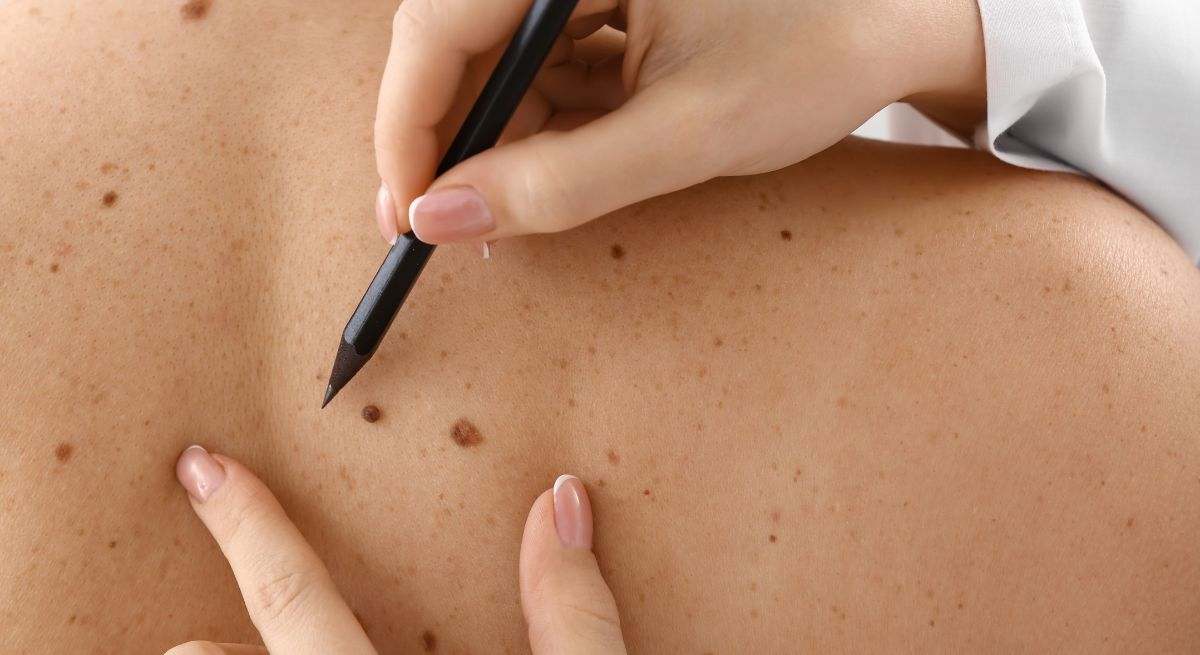 El cáncer de piel es un tipo de tumor frecuente