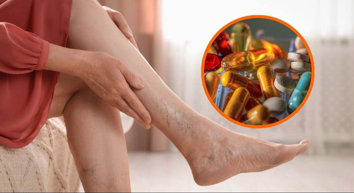 Vitaminas para las varices