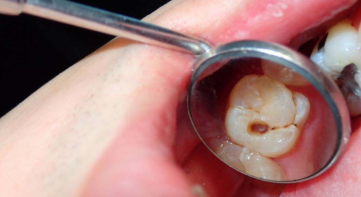 Caries en los dientes