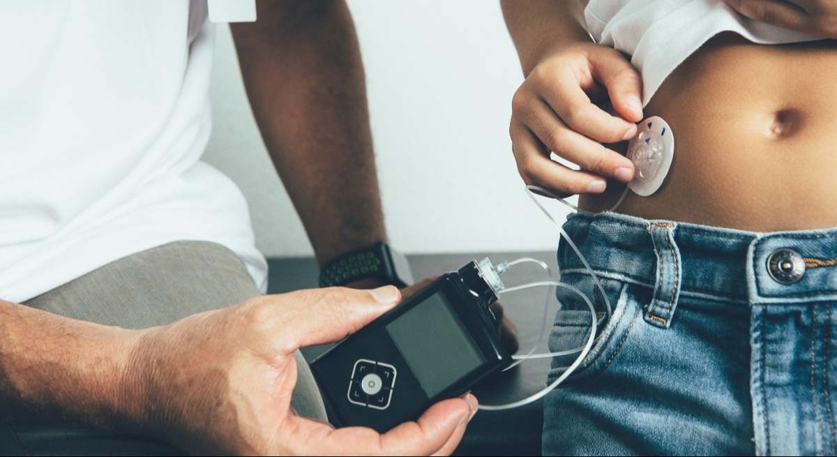 Bomba de insulina para pacientes con diabetes.