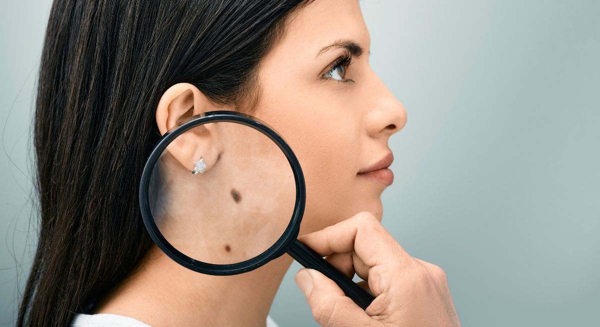 El cáncer de piel es una enfermedad en la cual las células del piel comienzan a multiplicarse sin control