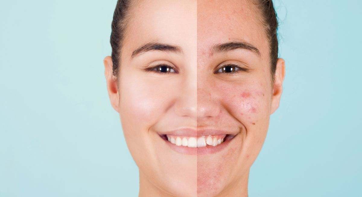 Joven con acné antes y después